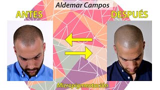 🇬🇧 ENG Antes usaba 👉MAQUILLAJE👈 para disimular las entradas Ahora la Micropigmentación Capilar [upl. by Rosane]