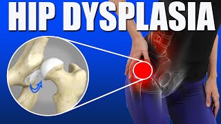 Hip Dysplasia l Pain Relief Exercises l Causes l Diagnosis l Symptoms [upl. by Akinnej]