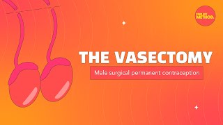 Vasectomy FAQs 🧐❓ [upl. by Savdeep908]