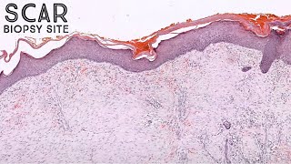 Scar amp biopsy site change under the microscope pathology dermpath dermatology dermatopathology [upl. by Cai]