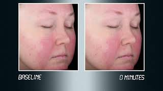 Het effect van Mirvaso gel op rosacea [upl. by Nitsug803]