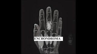 Enchondroma Tumor What You Need To Know [upl. by Anilemrac629]