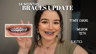 BRACES UPDATE  I got power chains  elastics  14 month progress [upl. by Reagan768]