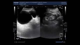 Ultrasound Video showing two cases Diverticulum of the urinary bladder and Prostatic Utricle Cyst [upl. by Rellia]