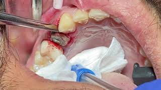 Tooth extraction using straight elevator [upl. by Enenstein466]