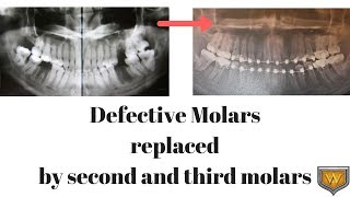 Defective molars replaced by second and third molars [upl. by Nealson]