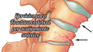 Ejercicios para FRACTURA VERTEBRAL POR ACUÑAMIENTO ANTERIOR  Vértebra dorsolumbar [upl. by Nylyaj]