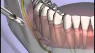 Malameds Local Anesthesia 11 Supplemental Injection Techniques [upl. by Lytle]