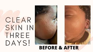 HOW I CLEARED MY NEWBORN’S ACNE amp ECZEMA IN THREE DAYS  WHAT REALLY WORKS [upl. by Htidra732]