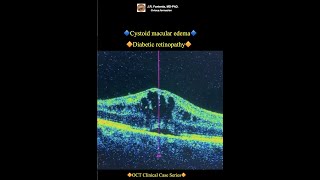 Cystoid macular edema Diabetic retinopathy [upl. by Anrat]