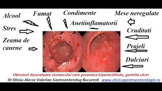 Cum calmam aciditatea gastrica prin regim [upl. by Hnilym]