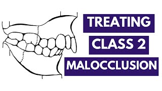 Management of Class 2 Malocclusion Orthodontics [upl. by Mortie]