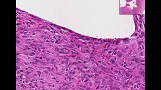 Histopathology ElbowChronic fibrinous bursitis [upl. by Nellek]