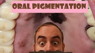 The ULTIMATE Pigmented Oral Lesion Review Video [upl. by Acirdna]