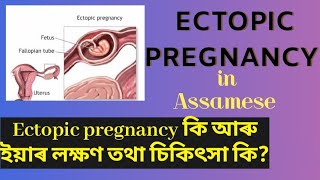 Ectopic pregnancy in AssameseEctopic pregnancy signs and symptomswhat is ectopic pregnancy [upl. by Paddy281]