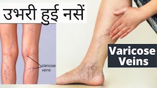 Varicose veins  उभरी हुई नसें  varicose vein treatment  Spider Veins [upl. by Evol]