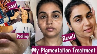 My Pigmentation Treatment  Yellow Peeling for dark spots pigmentation darkspots treatment [upl. by Prudhoe456]