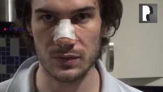 8 Male Rhinoplasty Nose Job Diary Day 6 After Surgery [upl. by Terena]