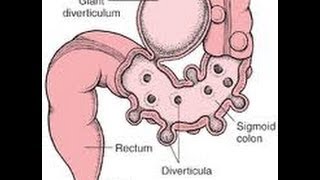 Top 3 Ways To Prevent Diverticulitis Attacks [upl. by Roldan]