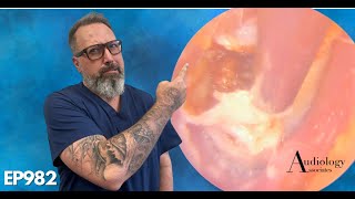 Most Satisfying Ear Wax And Thick Dead Skin Removal From Ear   EP982 [upl. by Ailahtan]