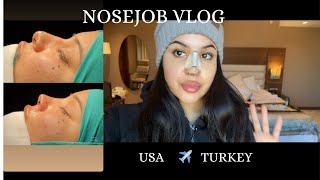 I FLEW TO TURKEY ALONE FOR A NOSEJOB Rhinoplasty results recovery amp 2 year update [upl. by Voss]