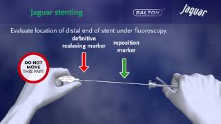 SELFEXPANDING NITINOL STENT quotJAGUARquot with delivery system [upl. by Enairb]