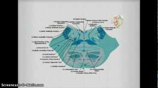 Medial Inferior Pontine Syndrome pics [upl. by Coveney]