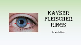 Corneal pigment lines  Kayser Fleischer ring  Fleischer ring [upl. by Eugeniusz419]