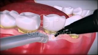 General Project  Dental Laser System 4x4 EN [upl. by Ardnajela]