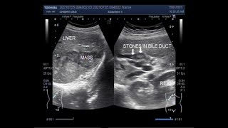 Distended Gallbladder with Cholelithiasis associated with Choledocholithiasis and Hepatic Mass [upl. by Sedrul194]