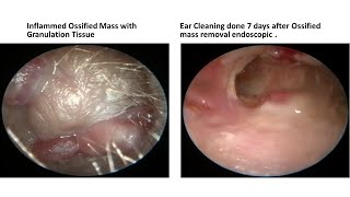 Ear Canal Inflamed Ossified Mass with Granulation Tissue [upl. by Anallise]