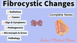 Fibrocystic Changes  Breast  Pathology  Hindi [upl. by Aihsirt]