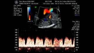 ductus venosus doppler [upl. by Nesmat]