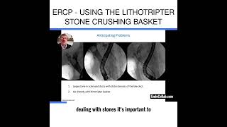 ERCP  Using the Lithotripter Stone Crushing Basket [upl. by Athalia281]