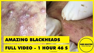 Full Video 1hour 46s AMAZING INFLAMED BLACKHEADS POPPING [upl. by Acirne]