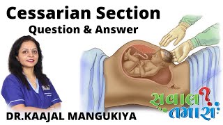 Cessarian Section Question amp Answer Sawal Tamata By DrKaajal Mangukiya [upl. by Leigh]