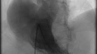 Video 3 — Hypoxemia from patent foramen ovale in a woman with carcinoid heart disease [upl. by Anikal]