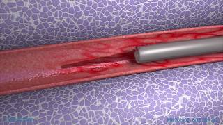 Peripheral IV Phlebitis Animation [upl. by Secnirp]