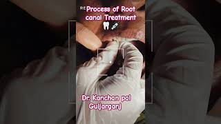 Process of Root canal TreatmentCavity Removal bdshorts dental smile dental rootcanaltreatment [upl. by Llerrehs]