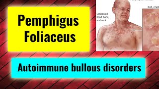 Pemphigus Foliaceus overview treatment management Autoimmune bullous disorders Part 3 [upl. by Akire63]