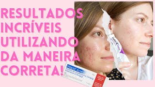 VITACID ACNE Como usar efeitos colaterais funciona Clindamicina  Tretinoína  ACNE E MANCHAS 💦 [upl. by Mathilda]