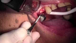 CAMLOG Implant Placement 5 Site Flap Design amp Pilot Hole [upl. by Gnoix]