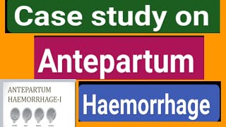 Case study on Antepartum haemorrhage videosyoutubevideosviral [upl. by Aicirpac]