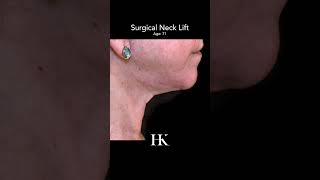 Surgical Neck Lift Before and After performed by Dr Khorasani  NYC Surgeon [upl. by Goat]