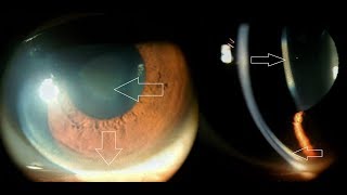 Keratoconus Part 2 Compilation of clinical signs Vogts striae Fleischer ring Hydrops etc [upl. by Kan769]