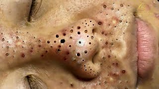 Big Cystic Acne Blackheads Extraction Blackheads amp Milia Whiteheads Removal Pimple Popping  3799 [upl. by Benkley]