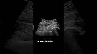 ultrasound Guided Interventions Cases Hip Joint PRP Injection [upl. by Arrac]