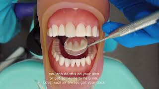 How to fix your chipped tooth at home beautifully [upl. by Shaya]