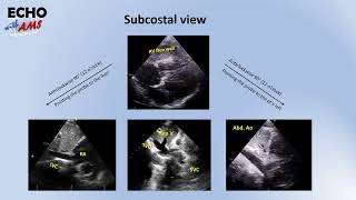 Protocol TTE subcostal suprasternal right parasternal views [upl. by Map]