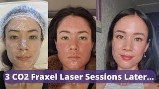 CO2 Fraxel Laser Review 3 Sessions Later  Did My Old Atrophic Acne Scars Improve  michxmash [upl. by Ellehcrad608]